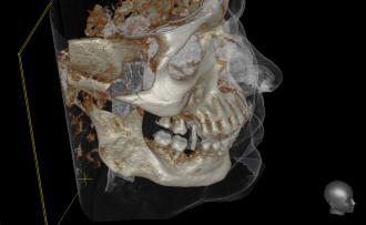 Röntgengerät für die digitale Volumentomographie (DVT) - Mund-, Kiefer- und Gesichtschirurgie, Implantologie & plastische Operationen Dres. Hilscher & Kollegen in 86316 Friedberg