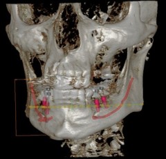 3D-Röntgendiagnostik / DVT - Mund-, Kiefer- und Gesichtschirurgie, Implantologie & plastische Operationen Dres. Hilscher & Kollegen in 86316 Friedberg