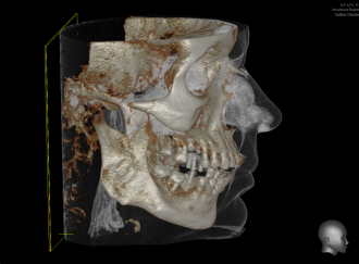 3D-Röntgendiagnostik / DVT - Mund-, Kiefer- und Gesichtschirurgie, Implantologie & plastische Operationen Dres. Hilscher & Kollegen in 86316 Friedberg